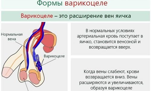 Варикоцеле 2 степени: симптомы, причины, оперативное лечение (осложнения), лечение без операции (медикаменты, народное), профилактика, последствия