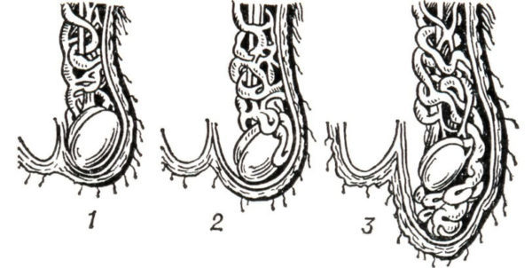 Варикоцеле 2 степени: симптомы, причины, оперативное лечение (осложнения), лечение без операции (медикаменты, народное), профилактика, последствия