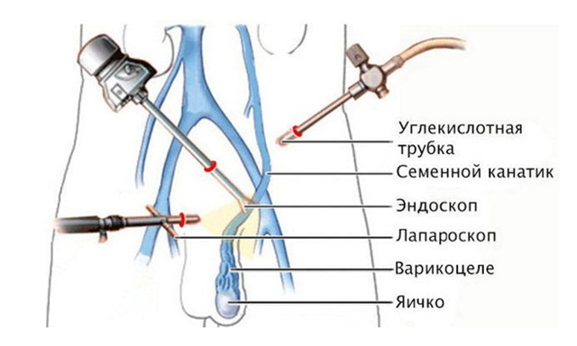 Варикоцеле 3 степени: причины, симптомы, диагностика, оперативное лечение, осложнения, профилактика, можно ли иметь детей