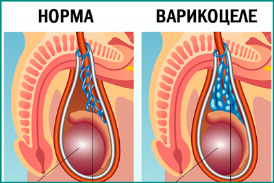 Варикоцеле 3 степени: причины, симптомы, диагностика, оперативное лечение, осложнения, профилактика, можно ли иметь детей