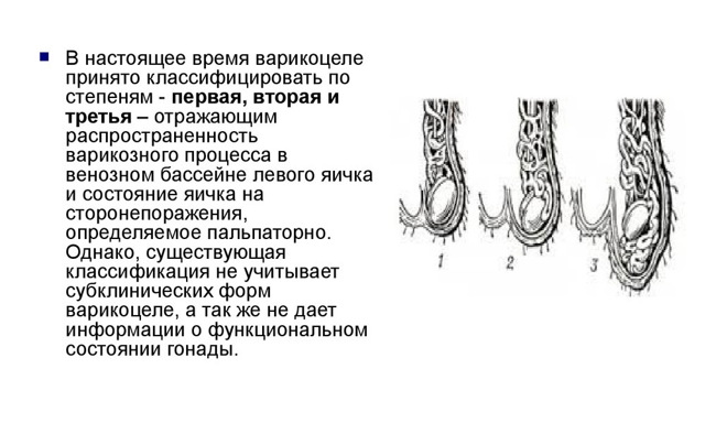 Варикоцеле 3 степени: причины, симптомы, диагностика, оперативное лечение, осложнения, профилактика, можно ли иметь детей