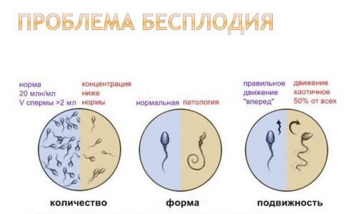Варикоцеле 3 степени: причины, симптомы, диагностика, оперативное лечение, осложнения, профилактика, можно ли иметь детей