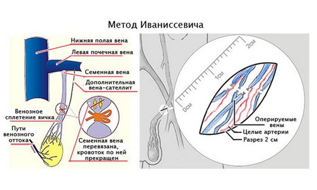 Варикоцеле 3 степени: причины, симптомы, диагностика, оперативное лечение, осложнения, профилактика, можно ли иметь детей