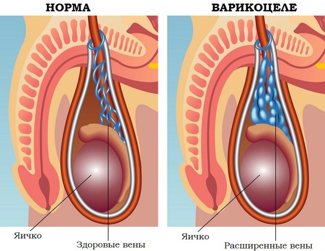 Варикоцеле у детей: стадии, симптомы, причины, диагностика, лечение (хирургическое, народное), осложнения, профилактика