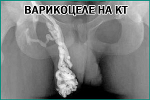 Варикоцеле у подростков (14-17 лет): нужна ли операция, лечение, фото (1, 2 степень), причины, отзывы