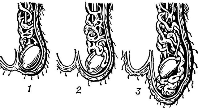 Варикоцеле у подростков (14-17 лет): нужна ли операция, лечение, фото (1, 2 степень), причины, отзывы