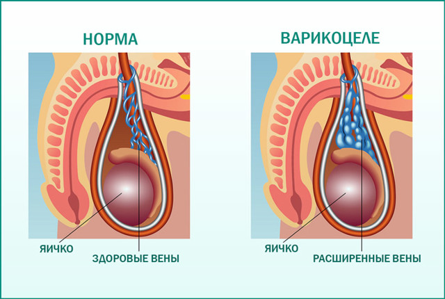 Варикоцеле у подростков (14-17 лет): нужна ли операция, лечение, фото (1, 2 степень), причины, отзывы