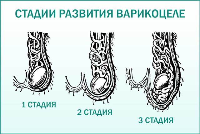 Варикоцеле у подростков (14-17 лет): нужна ли операция, лечение, фото (1, 2 степень), причины, отзывы