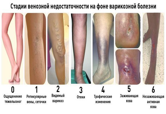 Варикоз глубоких вен нижних конечностей: симптомы, лечение, профилактика и осложнения