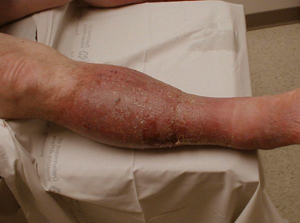 Варикоз глубоких вен нижних конечностей: симптомы, лечение, профилактика и осложнения