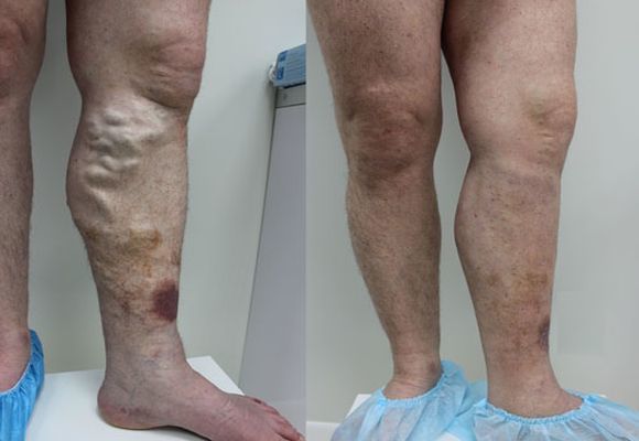 Варикоз глубоких вен нижних конечностей: симптомы, лечение, профилактика и осложнения