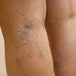 Варикоз глубоких вен нижних конечностей: симптомы, лечение, профилактика и осложнения