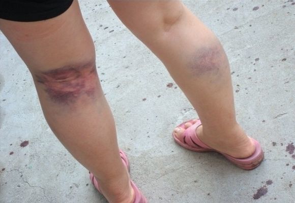 Варикоз глубоких вен нижних конечностей: симптомы, лечение, профилактика и осложнения