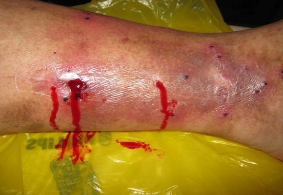 Варикоз глубоких вен нижних конечностей: симптомы, лечение, профилактика и осложнения