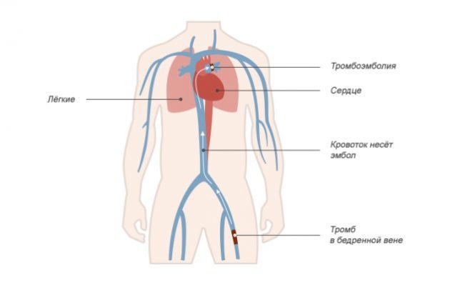 Варикоз глубоких вен нижних конечностей: симптомы, лечение, профилактика и осложнения