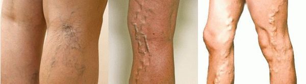 Варикоз глубоких вен нижних конечностей: симптомы, лечение, профилактика и осложнения