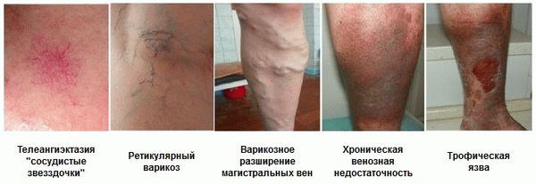 Варикоз глубоких вен нижних конечностей: симптомы, лечение, профилактика и осложнения