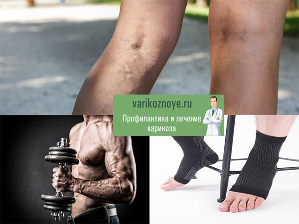Варикоз на ногах у мужчин: как лечить, симптомы и признаки, чем опасен, профилактика, последствия