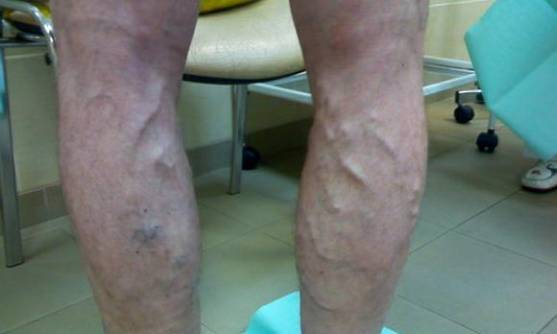 Варикоз на ногах у мужчин: как лечить, симптомы и признаки, чем опасен, профилактика, последствия