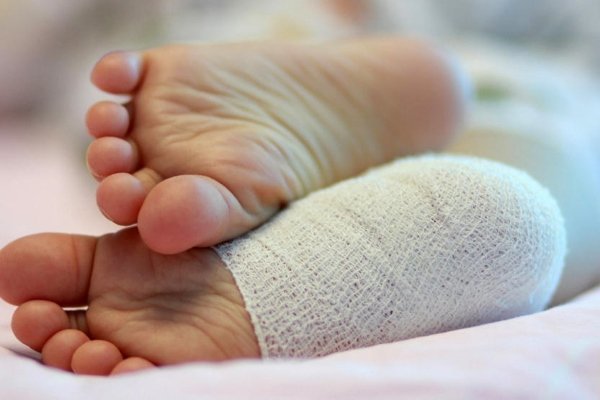 Варикоз на ногах у мужчин: как лечить, симптомы и признаки, чем опасен, профилактика, последствия