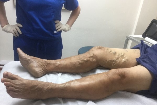 Варикоз на ногах у мужчин: как лечить, симптомы и признаки, чем опасен, профилактика, последствия