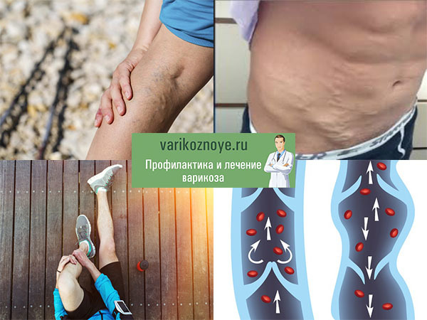 Варикоз на ногах у мужчин: как лечить, симптомы и признаки, чем опасен, профилактика, последствия