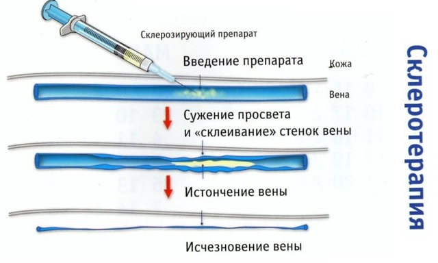 Варикоз на ногах у мужчин: как лечить, симптомы и признаки, чем опасен, профилактика, последствия