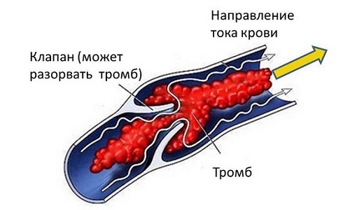 Варикоз на ногах у мужчин: как лечить, симптомы и признаки, чем опасен, профилактика, последствия