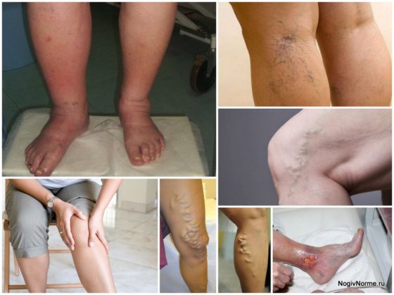 Варикоз на ногах у женщин: причины, симптомы, диагностика, стадии, лечение (медикаментозное, оперативное, народное), профилактика, осложнения