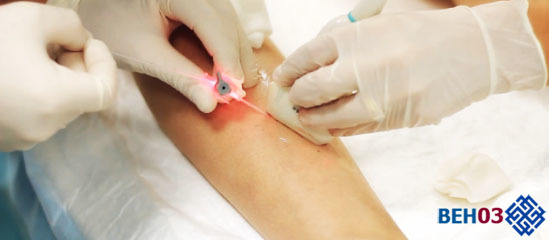 Варикоз на ногах у женщин: причины, симптомы, диагностика, стадии, лечение (медикаментозное, оперативное, народное), профилактика, осложнения