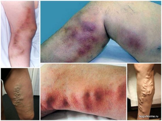 Варикоз на ногах у женщин: причины, симптомы, диагностика, стадии, лечение (медикаментозное, оперативное, народное), профилактика, осложнения