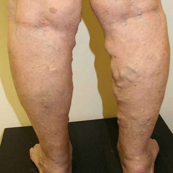 Варикоз на ногах у женщин: причины, симптомы, диагностика, стадии, лечение (медикаментозное, оперативное, народное), профилактика, осложнения