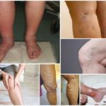 Варикоз на ногах у женщин: причины, симптомы, диагностика, стадии, лечение (медикаментозное, оперативное, народное), профилактика, осложнения