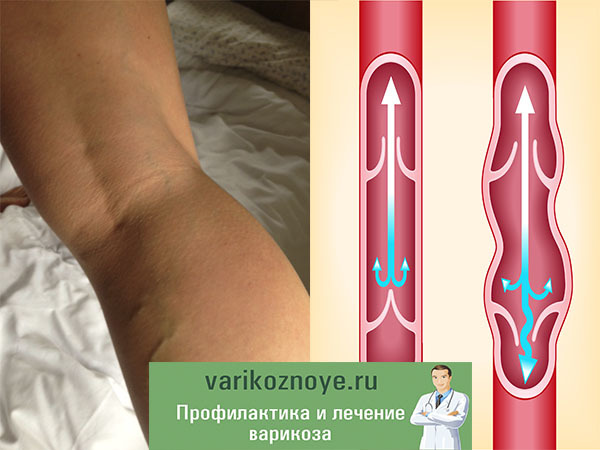 Варикоз на ногах у женщин: причины, симптомы, диагностика, стадии, лечение (медикаментозное, оперативное, народное), профилактика, осложнения
