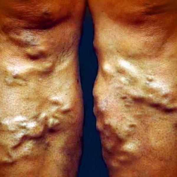 Варикоз на ногах у женщин: причины, симптомы, диагностика, стадии, лечение (медикаментозное, оперативное, народное), профилактика, осложнения