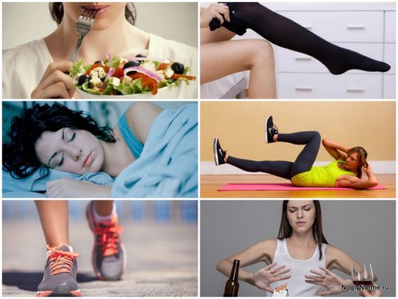 Варикоз на ногах у женщин: причины, симптомы, диагностика, стадии, лечение (медикаментозное, оперативное, народное), профилактика, осложнения