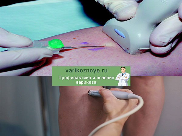 Варикоз на ногах у женщин: причины, симптомы, диагностика, стадии, лечение (медикаментозное, оперативное, народное), профилактика, осложнения