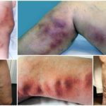 Варикоз на ногах у женщин: причины, симптомы, диагностика, стадии, лечение (медикаментозное, оперативное, народное), профилактика, осложнения