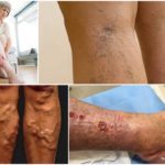 Варикоз на ногах у женщин: причины, симптомы, диагностика, стадии, лечение (медикаментозное, оперативное, народное), профилактика, осложнения