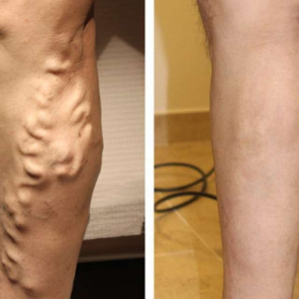 Варикоз на ногах у женщин: причины, симптомы, диагностика, стадии, лечение (медикаментозное, оперативное, народное), профилактика, осложнения