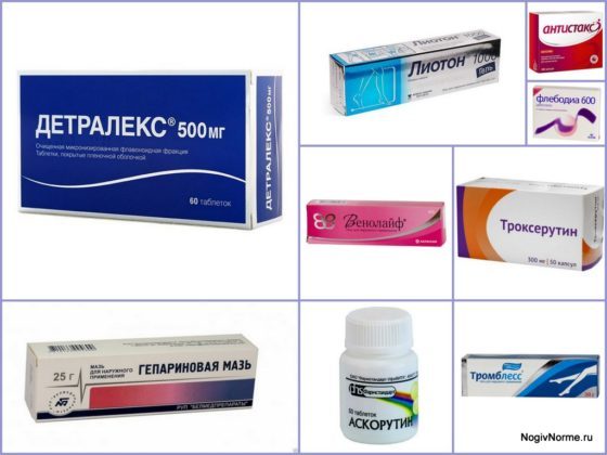 Варикоз на ногах у женщин: причины, симптомы, диагностика, стадии, лечение (медикаментозное, оперативное, народное), профилактика, осложнения