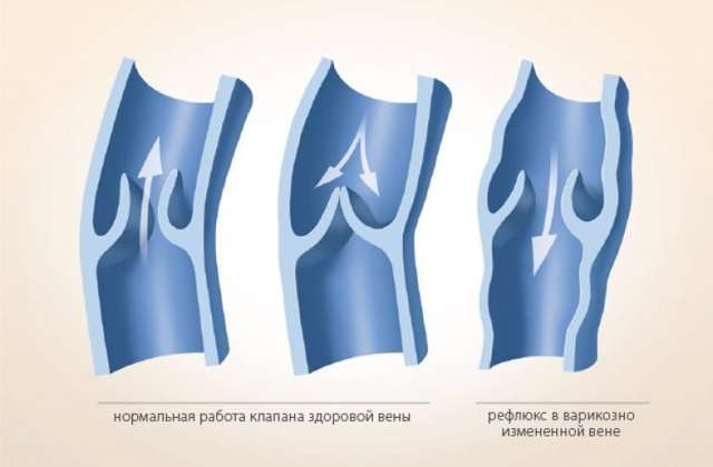 Варикоз на ногах у женщин: причины, симптомы, диагностика, стадии, лечение (медикаментозное, оперативное, народное), профилактика, осложнения