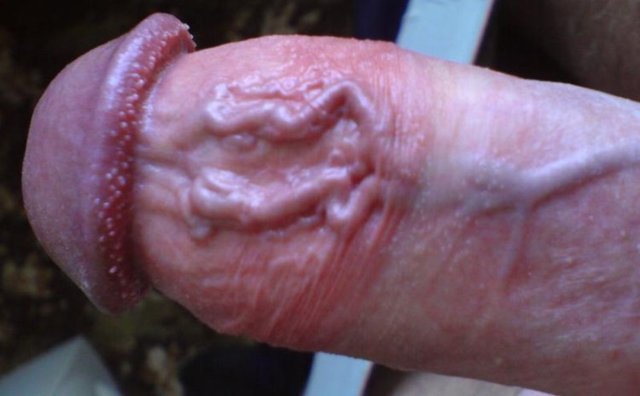 Варикоз на половом члене: причины, симптомы, стадии, диагностика, лечение (медикаменты, хирургия, народные способы), осложнения, профилактика