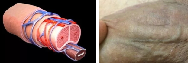 Варикоз на половом члене: причины, симптомы, стадии, диагностика, лечение (медикаменты, хирургия, народные способы), осложнения, профилактика