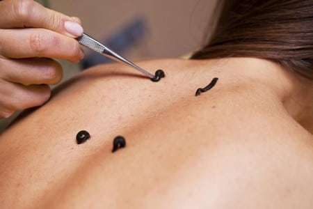 Варикоз на половом члене: причины, симптомы, стадии, диагностика, лечение (медикаменты, хирургия, народные способы), осложнения, профилактика