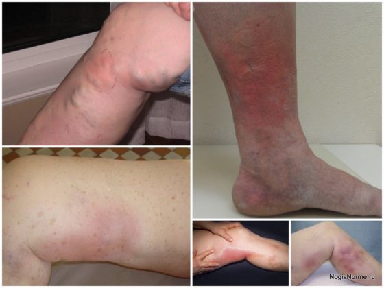 Варикоз: особенности при посещении солярия и принятия солнечных ванн и их влияние на развитие недуга