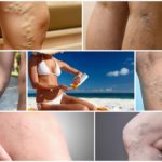 Варикоз: особенности при посещении солярия и принятия солнечных ванн и их влияние на развитие недуга