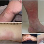 Варикоз: особенности при посещении солярия и принятия солнечных ванн и их влияние на развитие недуга