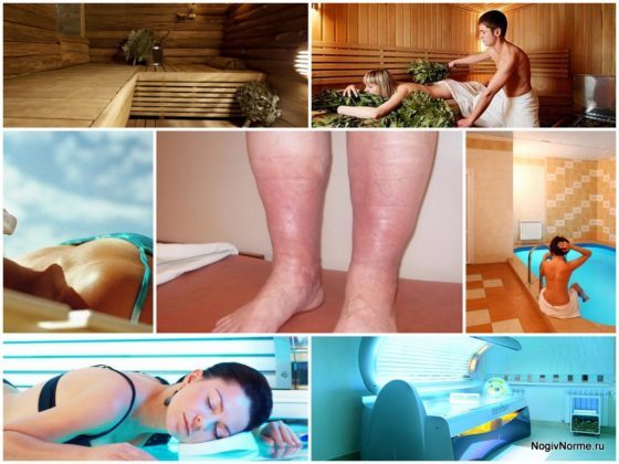 Варикоз: особенности при посещении солярия и принятия солнечных ванн и их влияние на развитие недуга