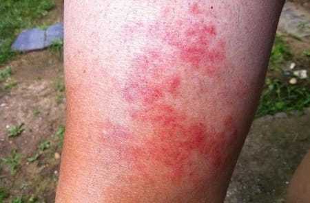 Варикоз: особенности при посещении солярия и принятия солнечных ванн и их влияние на развитие недуга